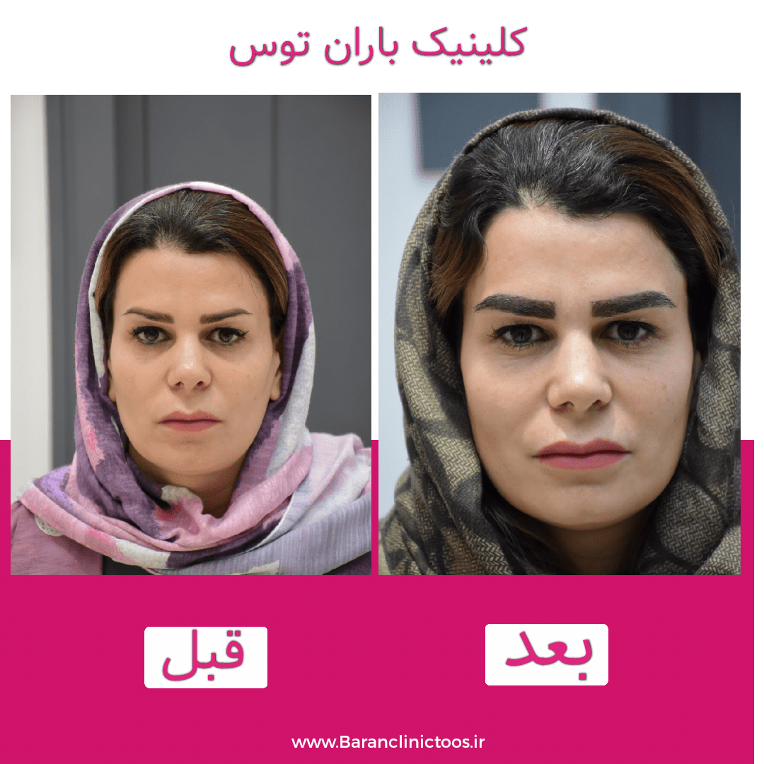 قبل و بعد کاشت ابرو